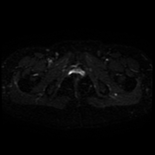 Cesarian section scar endometriosis (Radiopaedia 66520-75799 Axial DWI 23).jpg