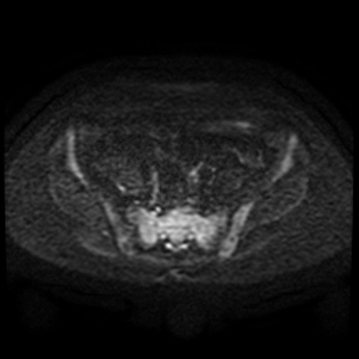 Cesarian section scar endometriosis (Radiopaedia 66520-75799 Axial DWI 80).jpg