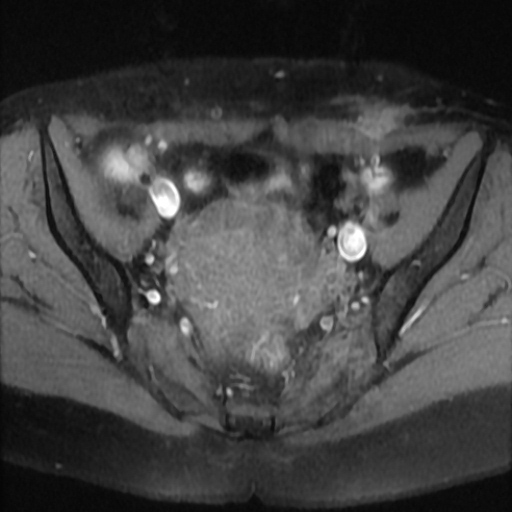 File:Cesarian section scar endometriosis (Radiopaedia 66520-75799 Axial T1 fat sat 10).jpg