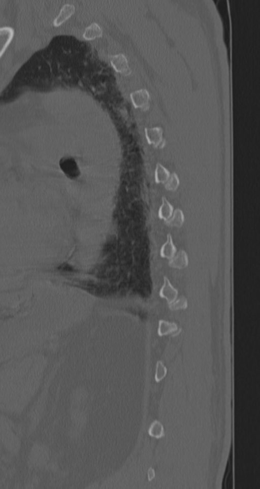 Chance fracture (Radiopaedia 33854-35020 Sagittal bone window 22).png