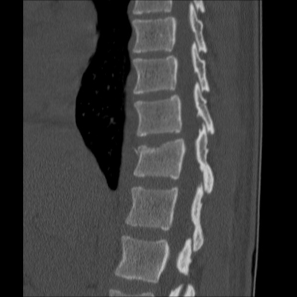 Chance fracture (Radiopaedia 36521-38081 Sagittal bone window 23).jpg