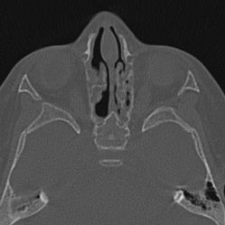 Choanal atresia (Radiopaedia 88525-105975 Axial bone window 62).jpg
