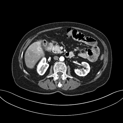 Cholecystoduodenal fistula due to calculous cholecystitis with gallstone migration (Radiopaedia 86875-103077 A 30).jpg