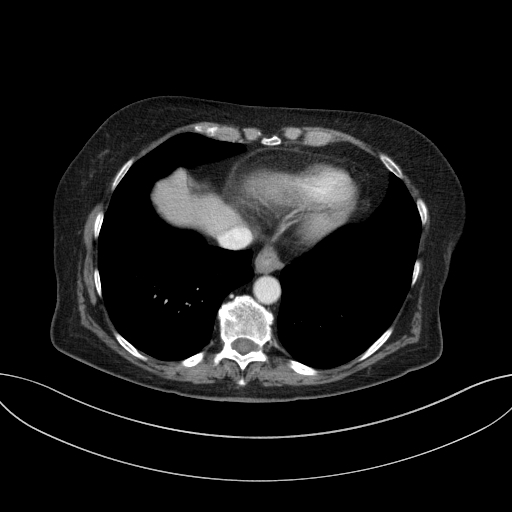 Cholecystoduodenal fistula due to calculous cholecystitis with gallstone migration (Radiopaedia 86875-103077 D 14).jpg