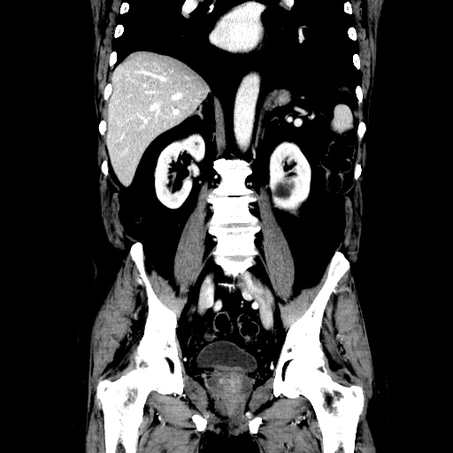 Choledocholiathiasis with normal caliber common bile duct (Radiopaedia 75368-86632 Coronal liver window 77).jpg