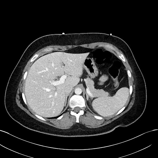 File:Choledocholithiasis after recent cholecystectomy (Radiopaedia 60929-68737 Axial 41).jpg