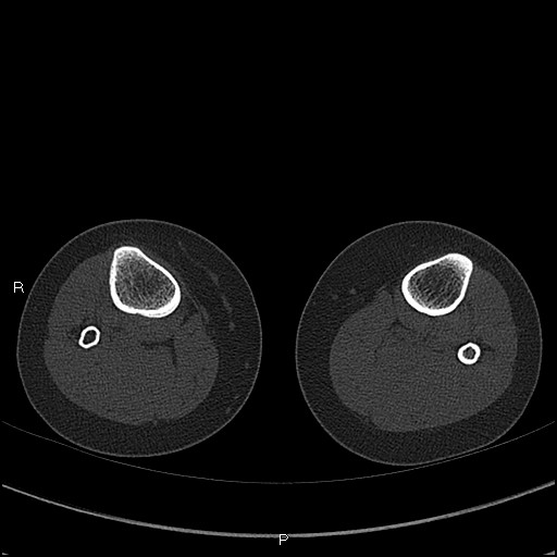 File:Chondroblastoma (Radiopaedia 62721-71030 Axial bone window 109).jpg
