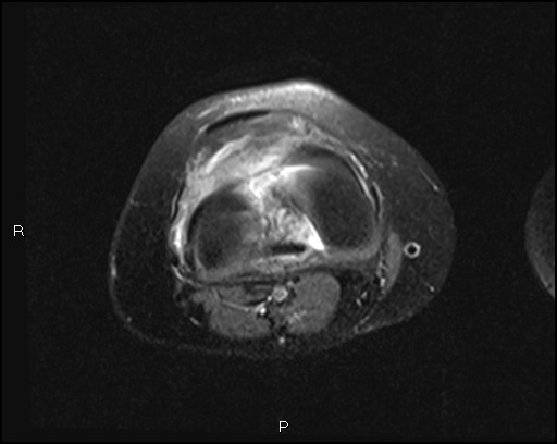File:Chondroblastoma (Radiopaedia 62721-71031 Axial PD fat sat 19).jpg