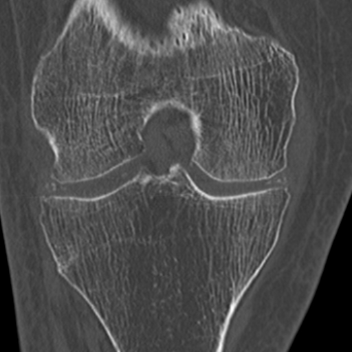 Chondrocalcinosis (Radiopaedia 16275-15955 Coronal bone window 32).jpg