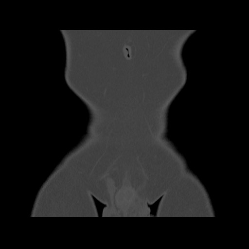 Chondrosarcoma of iliac wing (Radiopaedia 63861-72599 Coronal bone window 17).jpg
