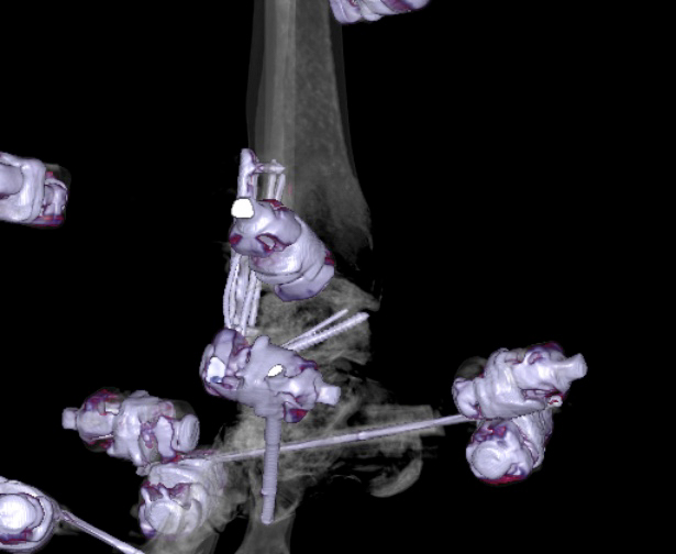 File:Chopart fracture (Radiopaedia 35347-36861 3D MPR bone window 17).jpg