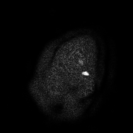 Chordoid glioma of third ventricle (Radiopaedia 91612-109340 F 3).jpg