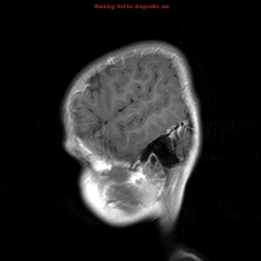 File:Choroid plexus papilloma (Radiopaedia 8466-9290 Sagittal T1 C+ 18).jpg