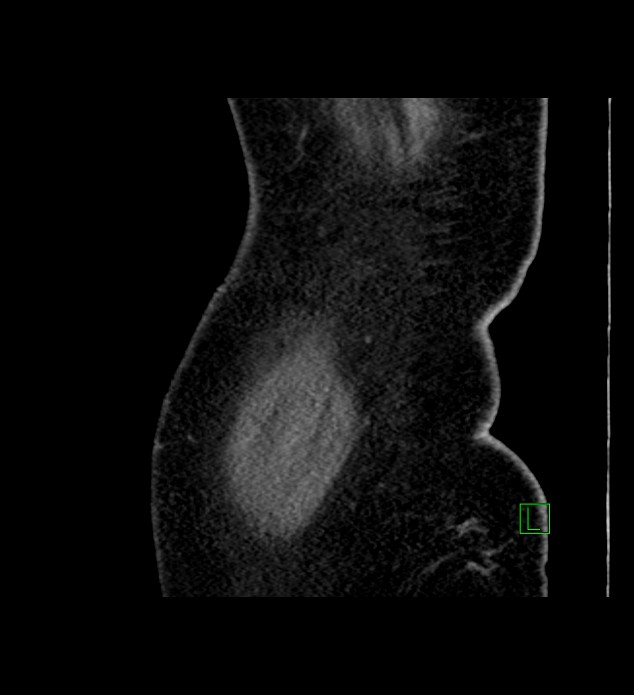 Chromophobe renal cell carcinoma (Radiopaedia 84239-99519 D 113).jpg