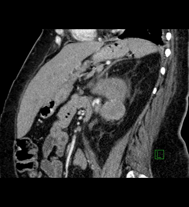 Chromophobe renal cell carcinoma (Radiopaedia 84239-99519 D 48).jpg