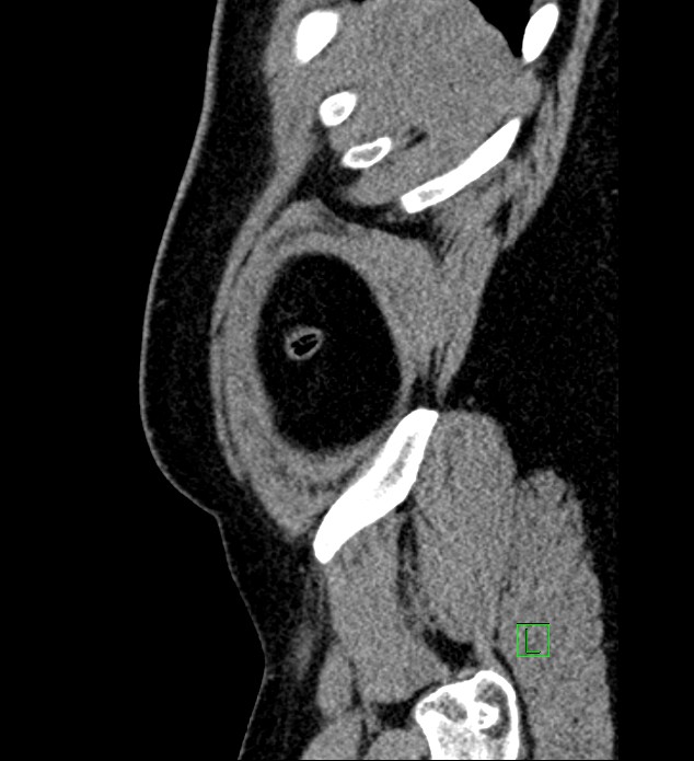 Chromophobe renal cell carcinoma (Radiopaedia 84286-99573 C 177).jpg