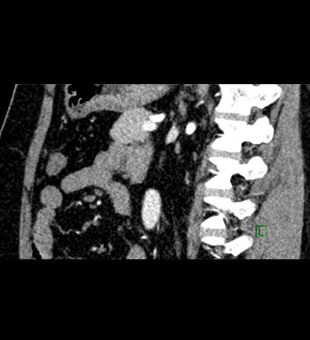Chromophobe renal cell carcinoma (Radiopaedia 84286-99573 F 70).jpg