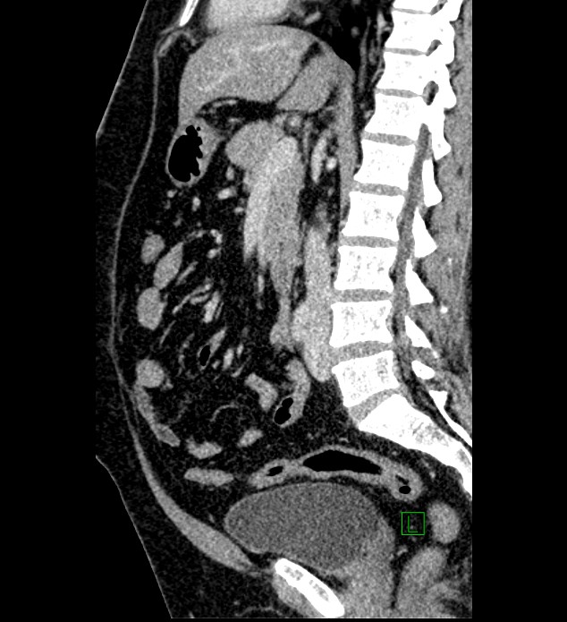 Chromophobe renal cell carcinoma (Radiopaedia 84286-99573 I 94).jpg