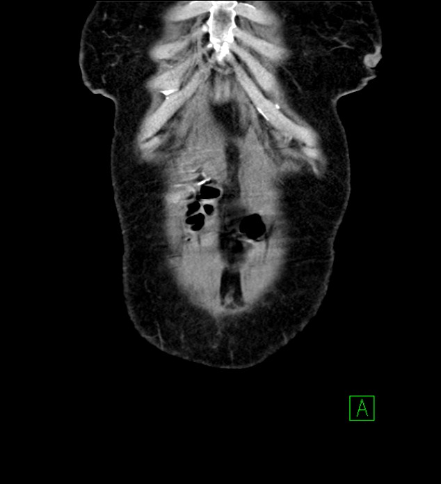 Chromophobe renal cell carcinoma (Radiopaedia 84290-99582 F 5).jpg