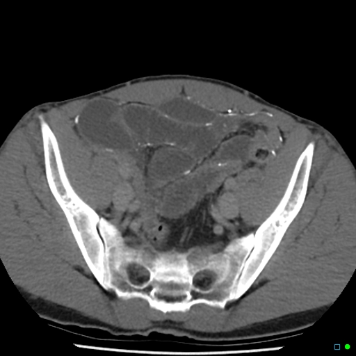 File:Chronic barium peritonitis and small bowel obstruction (Radiopaedia 29151-29548 D 13).jpg