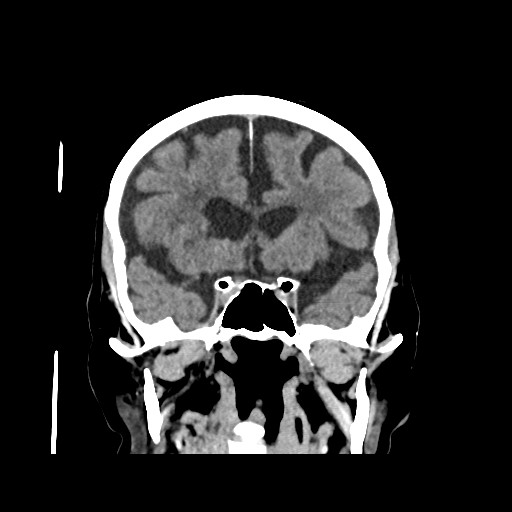 Chronic bilateral subdural hygroma (Radiopaedia 85801-101622 Coronal non-contrast 35).jpg
