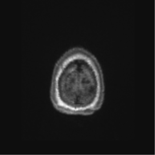 Chronic hypertensive encephalopathy (Radiopaedia 72844-83495 Axial T1 4).png
