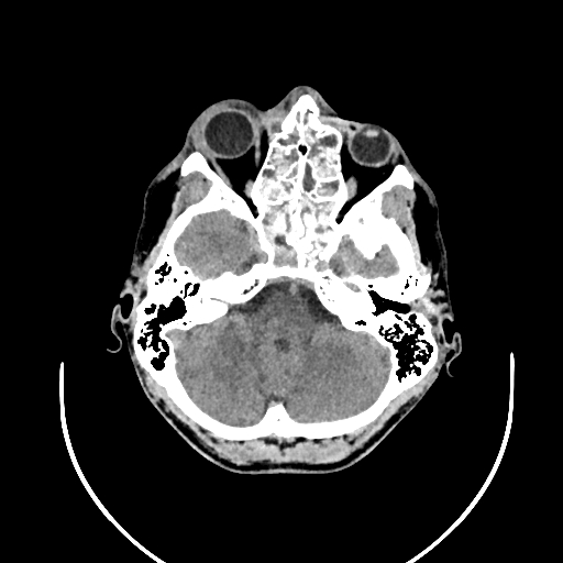 Chronic invasive fungal sinusitis (Radiopaedia 50342-55710 Axial non-contrast 41).jpg