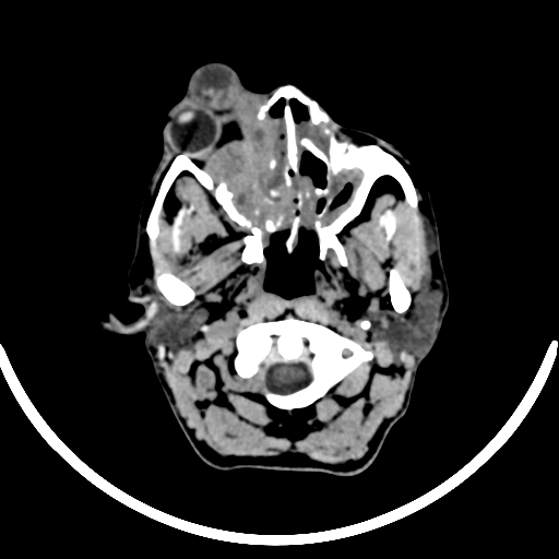 File:Chronic invasive fungal sinusitis with intraorbital and intracranial extension (Radiopaedia 56387-63046 Axial non-contrast 78).jpg