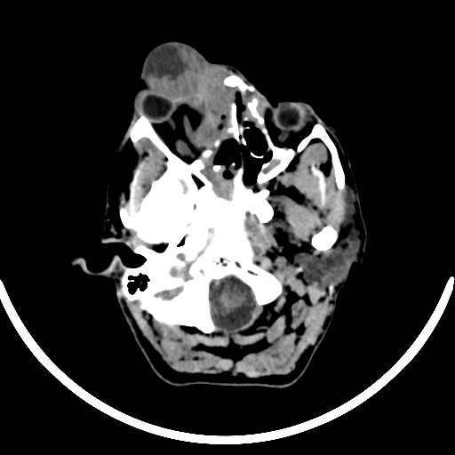 File:Chronic invasive fungal sinusitis with intraorbital and intracranial extension (Radiopaedia 56387-63046 Axial non-contrast 99).jpg
