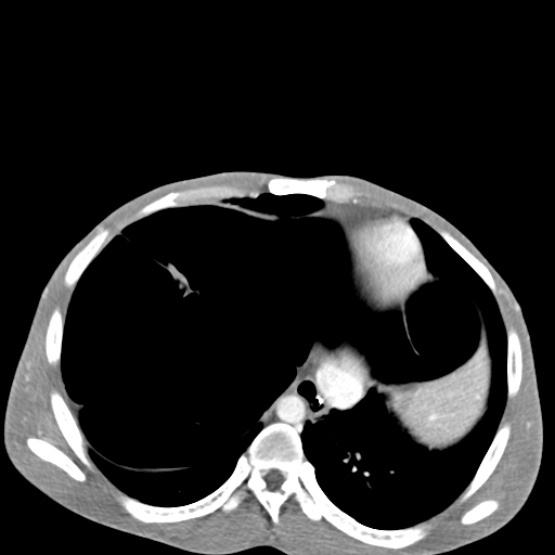 Chronic large bowel pseudo-obstruction (Radiopaedia 43181-46492 A 31).jpg