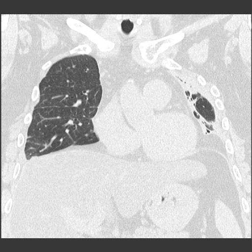 Chronic lung allograft dysfunction - restrictive form (Radiopaedia 60595-68316 Coronal lung window 45).jpg