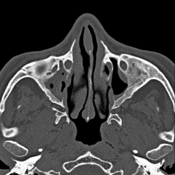 Chronic maxillary sinusitis (Radiopaedia 27879-28116 Axial bone window 19).jpg