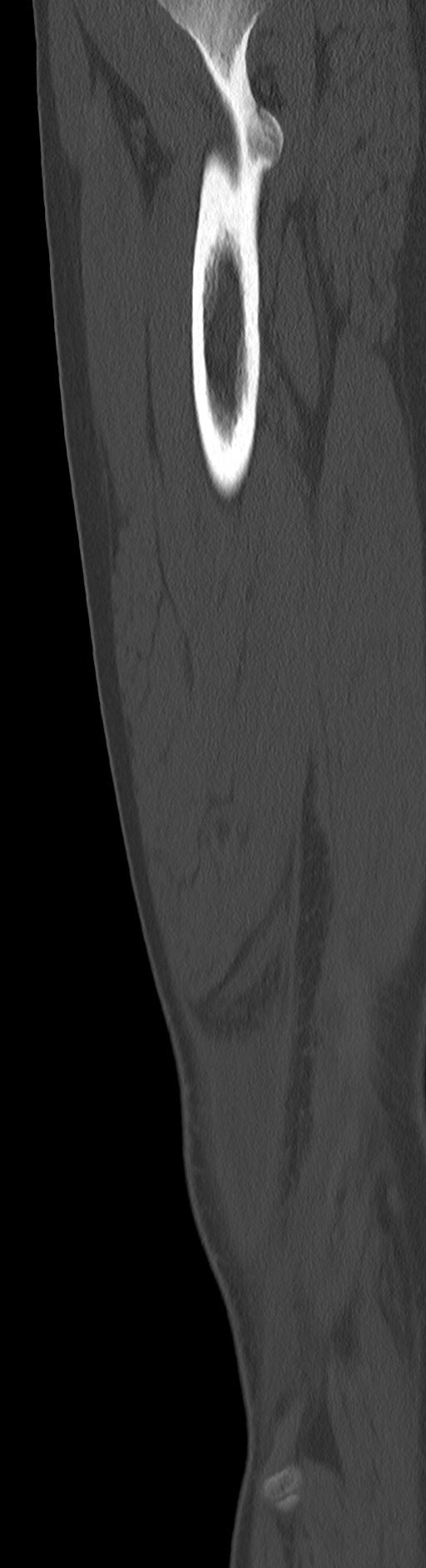 Chronic ostemyelitis of the femur with long sinus tract (Radiopaedia 74947-85982 Sagittal bone window 33).jpg