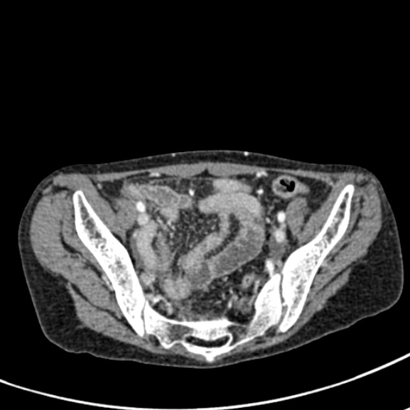 Chronic pancreatitis (Radiopaedia 55405-61846 A 86).jpg