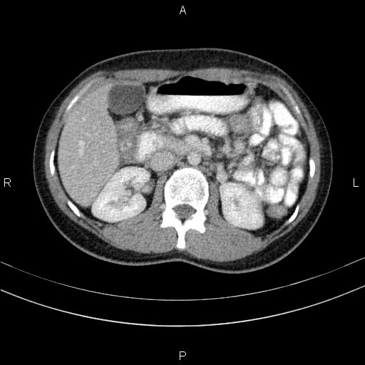 Chronic pancreatitis (Radiopaedia 64576-73450 C 64).jpg