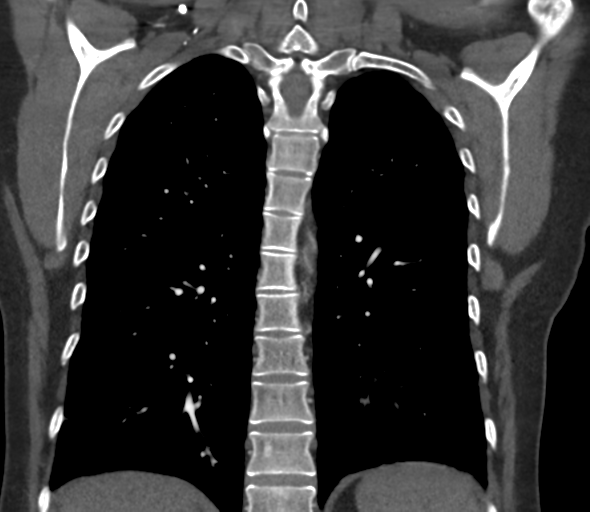 File:Chronic pulmonary embolus (Radiopaedia 39129-41341 Coronal C+ CTPA 61).png