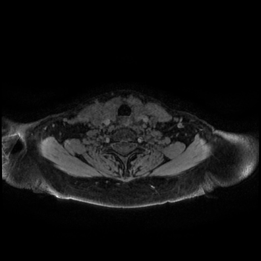 Chronic submandibular sialadenitis (Radiopaedia 61852-69885 Axial T1 C+ fat sat 2).jpg