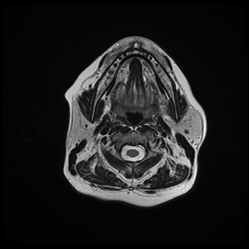 File:Chronic submandibular sialadenitis (Radiopaedia 61852-69885 Axial T2 12).jpg