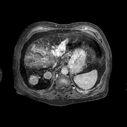 Cirrhosis and hepatocellular carcinoma in the setting of hemochromatosis (Radiopaedia 75394-86594 Axial T1 C+ fat sat 314).jpg