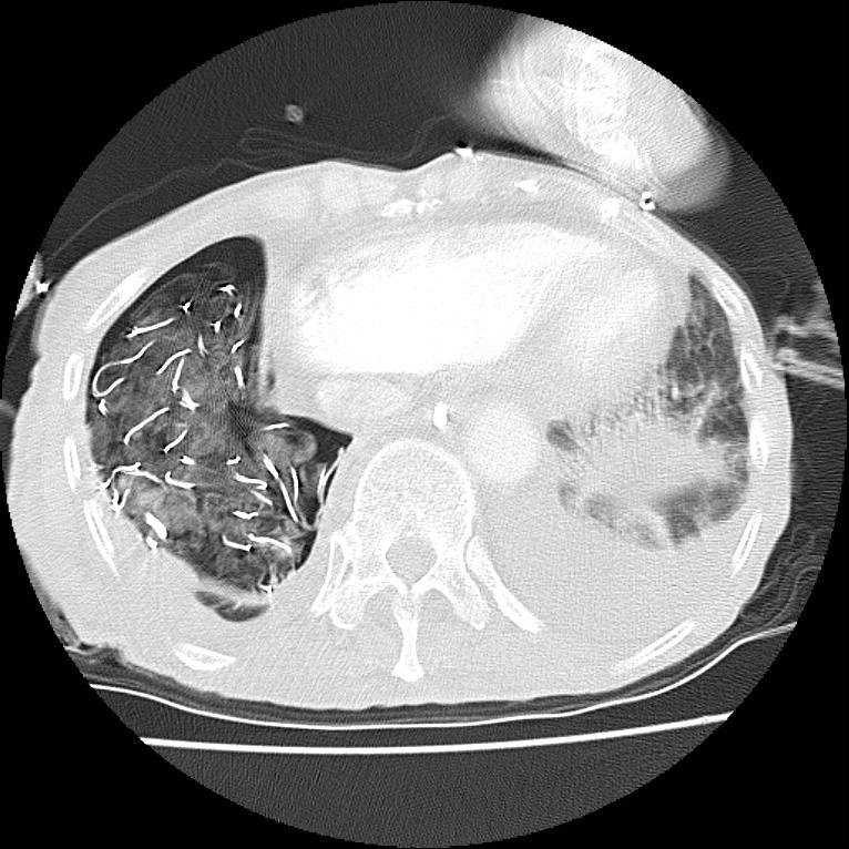 Clagett thoracotomy with bronchopleural fistula (Radiopaedia 29192-29587 Axial lung window 40).jpg