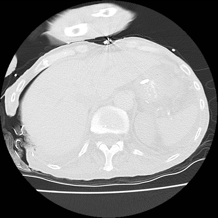 Clagett thoracotomy with bronchopleural fistula (Radiopaedia 29192-29587 Axial lung window 49).jpg
