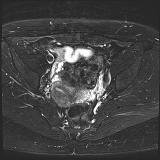 File:Class II Mullerian duct anomaly- unicornuate uterus with rudimentary horn and non-communicating cavity (Radiopaedia 39441-41755 Axial T2 fat sat 14).jpg