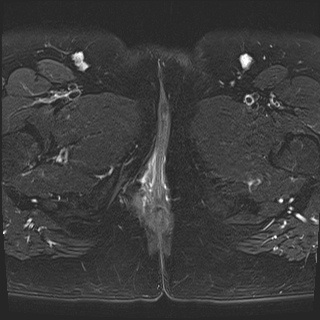 File:Class II Mullerian duct anomaly- unicornuate uterus with rudimentary horn and non-communicating cavity (Radiopaedia 39441-41755 Axial T2 fat sat 31).jpg