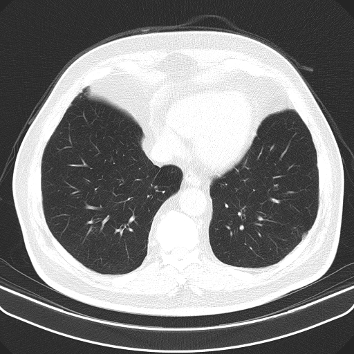 Classic complicated silicosis (Radiopaedia 49720-54961 Axial lung window 44).jpg