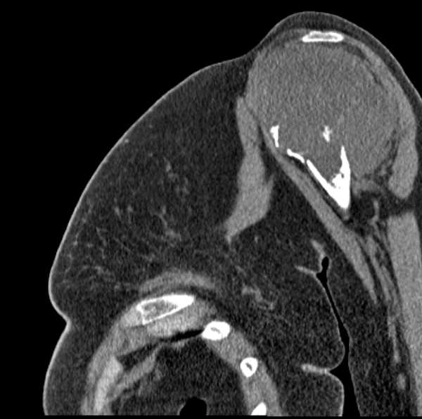 Clear cell chondrosarcoma - humerus (Radiopaedia 63104-71612 D 24).jpg