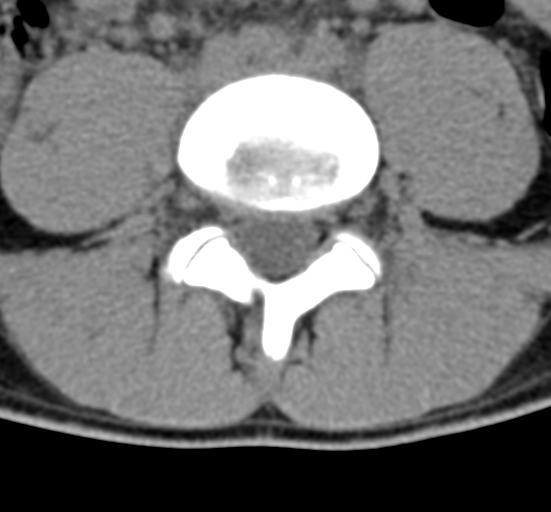 Clear cell meningoma - lumbar spine (Radiopaedia 60116-67691 Axial non-contrast 54).png