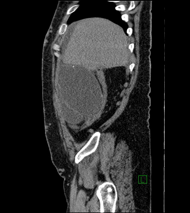 Closed-loop small bowel obstruction-internal hernia (Radiopaedia 78439-91096 C 119).jpg