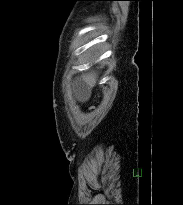 Closed-loop small bowel obstruction-internal hernia (Radiopaedia 78439-91096 C 131).jpg
