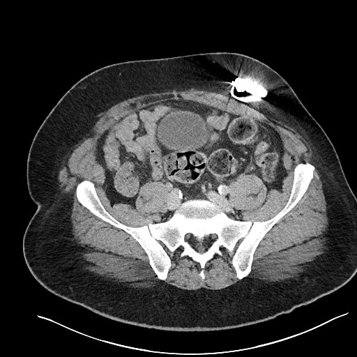 File:Closed loop obstruction - internal hernia into nephrectomy bed (Radiopaedia 59867-67320 A 104).jpg