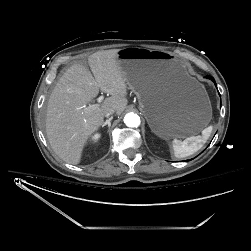 File:Closed loop obstruction due to adhesive band, resulting in small bowel ischemia and resection (Radiopaedia 83835-99023 B 37).jpg